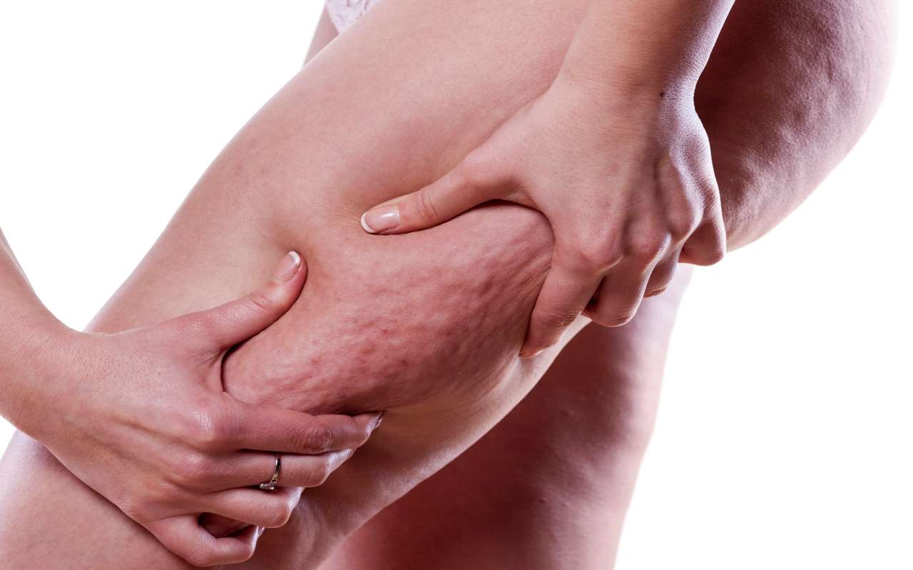 Coscia donna con la cellulite